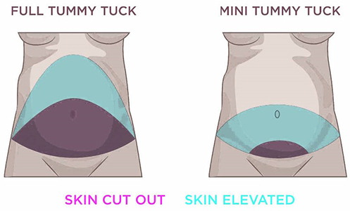 Mini Tuck vs. Full Tummy Tuck! Which is Right For Me? - Macleod